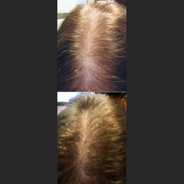 Before After RevivHair Max